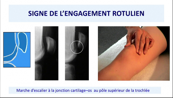 Mal de genou - Comprendre les douleurs du genou - approche clinique et biomécanique