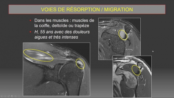 Radiological management of calcific tendinopathies of the rotator cuff: from diagnosis to treatment 