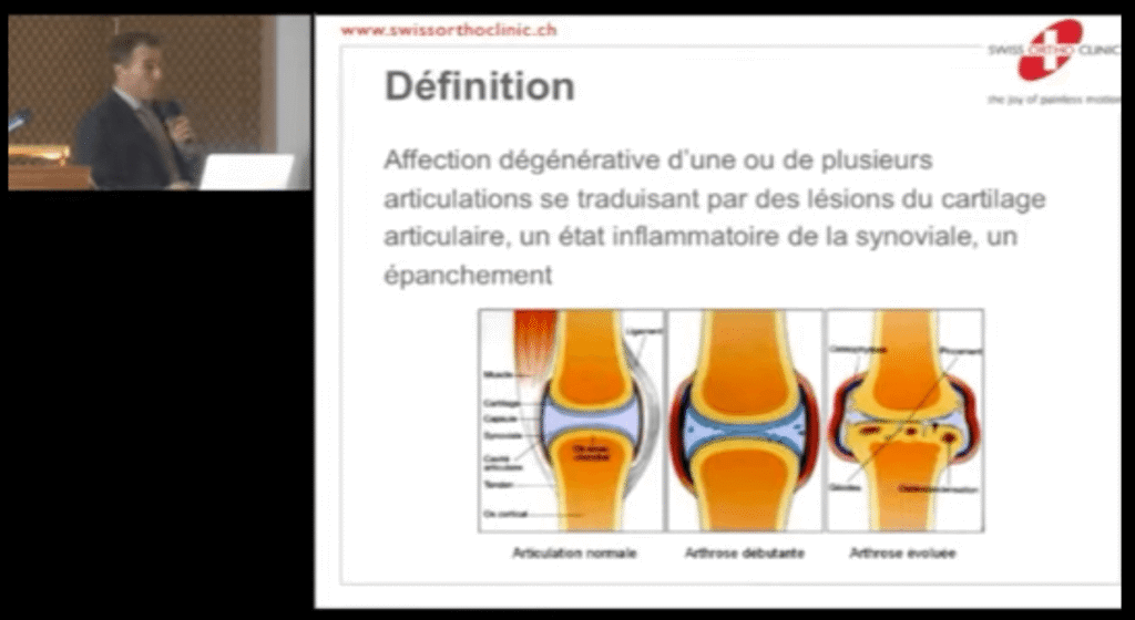 Causes et traitements de l’arthrose : une présentation claire