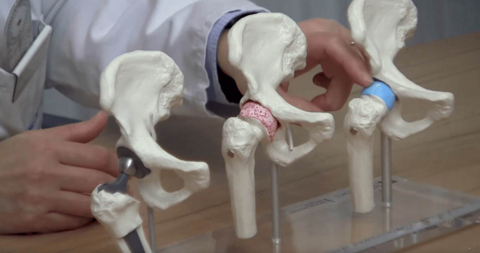 Understanding hip osteoarthritis and its treatments