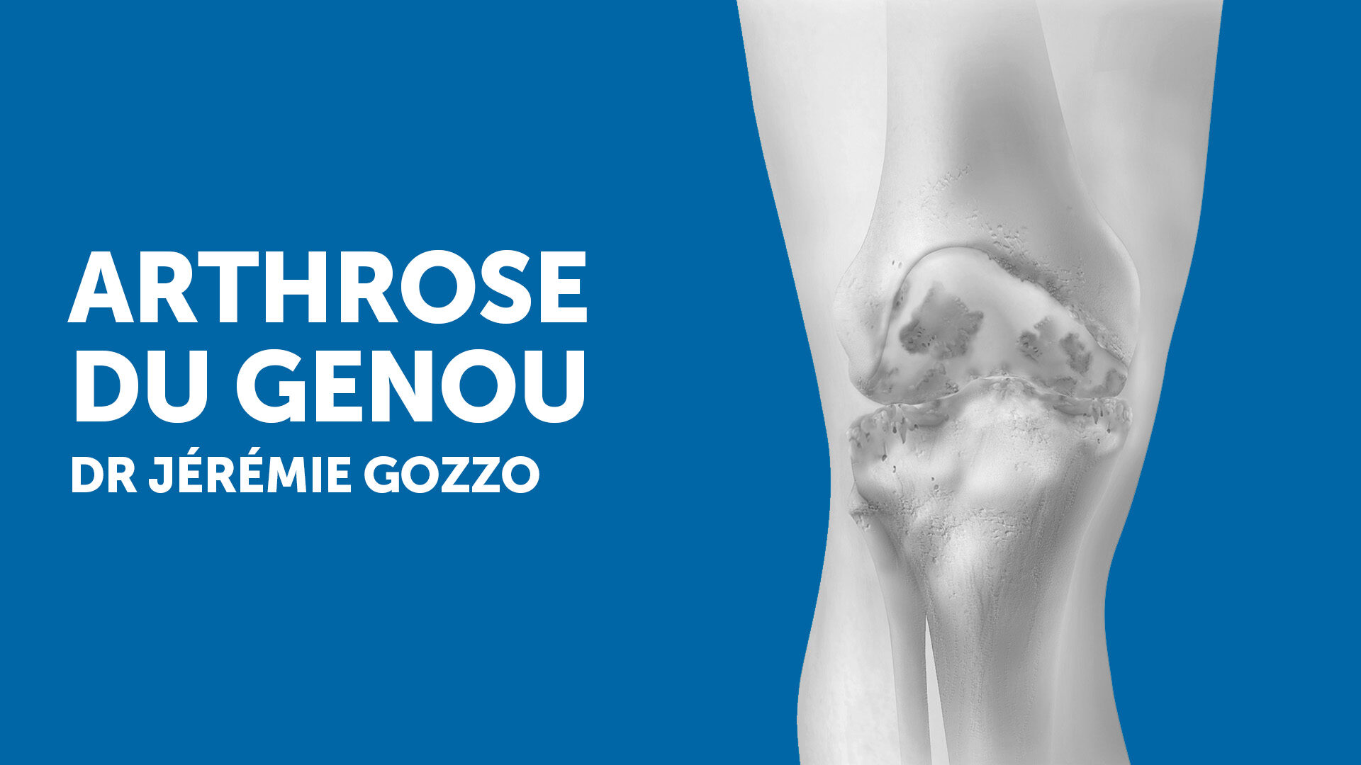 Understanding Knee Osteoarthritis: Symptoms and Treatments