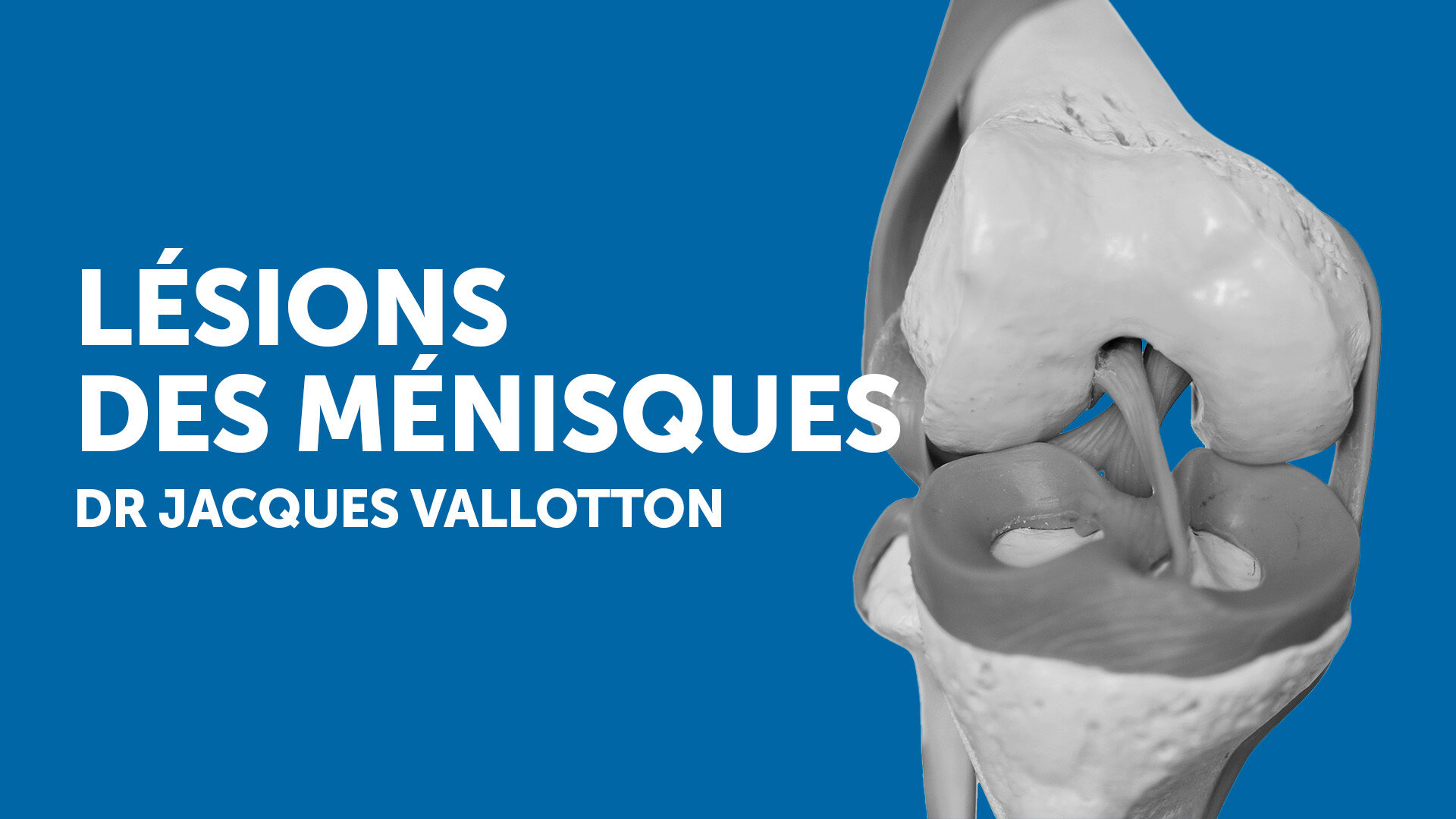 Comprendre les lésions du ménisque : faut-il toujours opérer ?