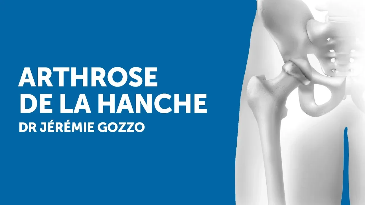 Hip Osteoarthritis: Symptoms, Causes, and Treatments