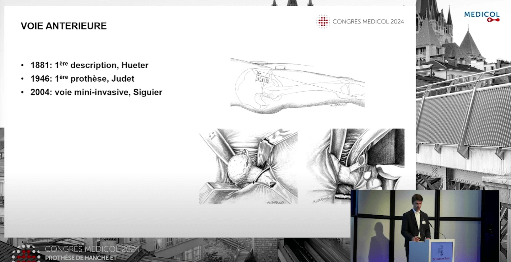 PTH which approach first - Dr. Hadrien Stolz