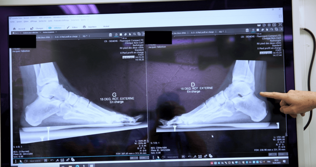 Arthroscopic technique of the retrotalar tunnel