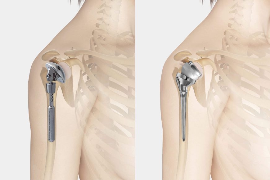 Orthopédiste de l’épaule à Lausanne – Pathologie: Arthrose de l’épaule Orthopédiste de l’épaule à Lausanne – Pathologie: Arthrose de l’épaule